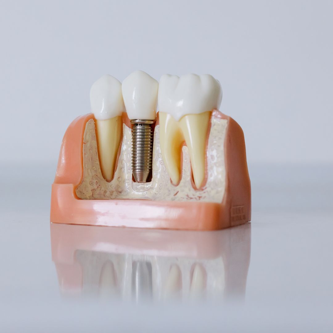 Financial Planning for Dental Implants Outside of NHIS Coverage in Korea